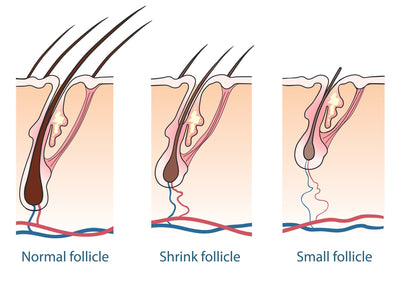 The Truth About Reversing Your Hair Loss