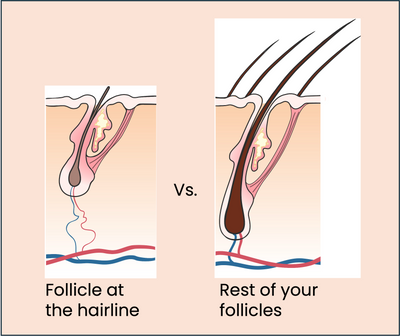 Why Your Hairline is More Vulnerable to Traction Alopecia